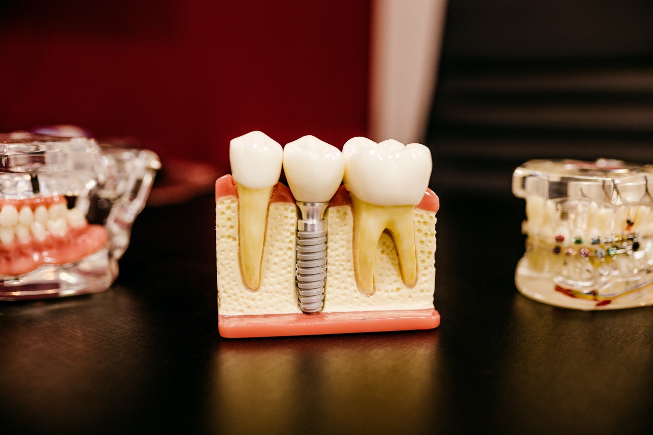 Implanty zębów – kiedy się je wykorzystuje?